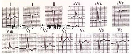 右脚ブロック+左脚前枝ブロック(二束ブロック) 右脚ブロック+左脚前枝ブロック(二束ブロック)