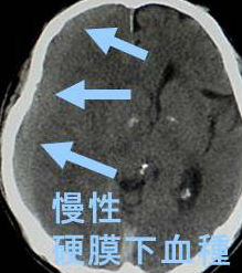慢性硬膜下血腫と甲状腺 慢性硬膜下血腫と甲状腺