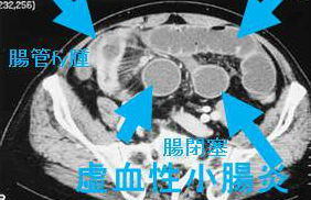 虚血性小腸炎 虚血性小腸炎