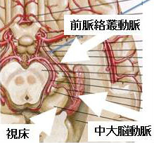 視床外側梗塞、内包後脚梗塞・前脈絡叢動脈梗塞による視床外側への脳浮腫 視床外側梗塞、内包後脚梗塞・前脈絡叢動脈梗塞による視床外側への脳浮腫