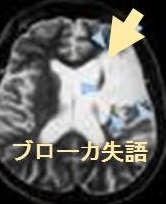 ブローカ失語 (運動性失語) ブローカ失語 (運動性失語)