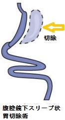 腹腔鏡下スリーブ状胃切除術 腹腔鏡下スリーブ状胃切除術