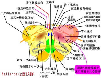 ワレンベルグ症候群 ワレンベルグ症候群