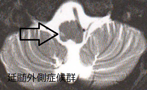 めまい、ふらつき、メニエールと甲状腺/動脈硬化[日本甲状腺学会認定 甲状腺専門医 橋本病 バセドウ病 甲状腺エコー検査 長崎甲状腺クリニック(大阪)]