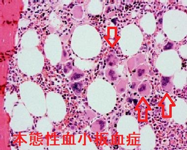 本態性血小板血症 骨髄 本態性血小板血症 骨髄