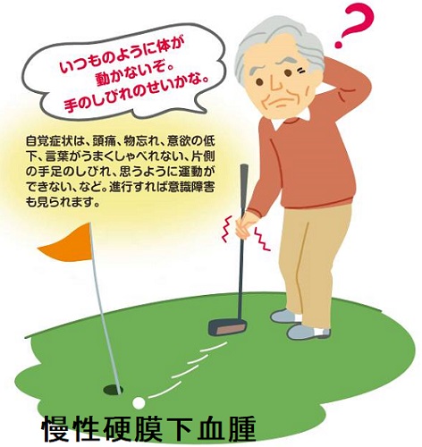 慢性硬膜下血腫 慢性硬膜下血腫