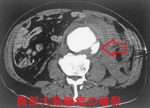 腹部大動脈瘤の破裂 造影CT 腹部大動脈瘤の破裂 造影CT