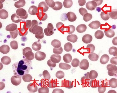 本態性血小板血症 末梢血塗抹標本 本態性血小板血症 末梢血塗抹標本