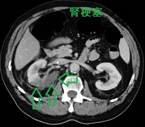 腎梗塞 造影CT画像 腎梗塞 造影CT画像