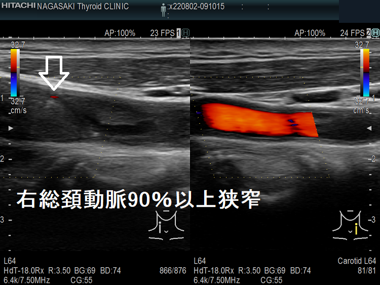 右総頚動脈90%以上狭窄 右総頚動脈90%以上狭窄