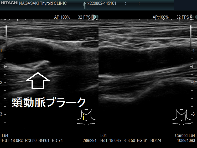 頸動脈プラーク 頸動脈プラーク