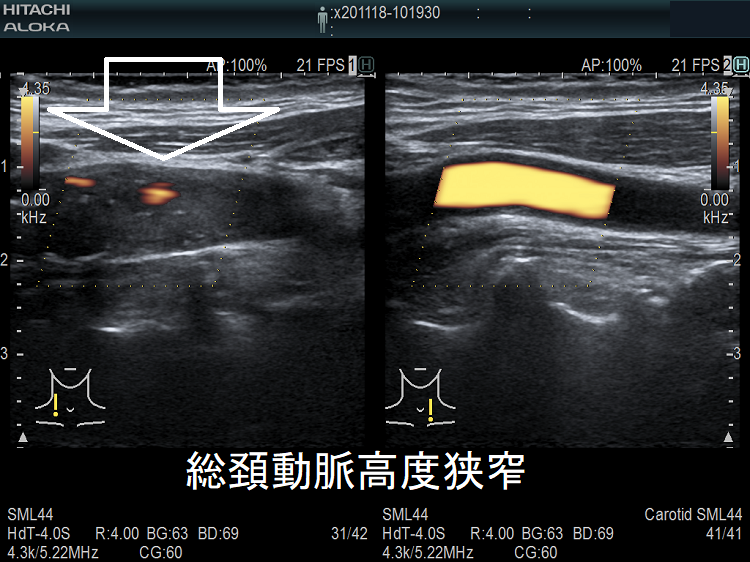 総頚動脈高度狭窄 超音波(エコー)画像 総頚動脈高度狭窄 超音波(エコー)画像