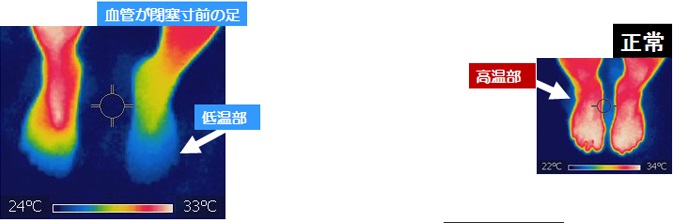 サーモグラフィー 糖尿足 サーモグラフィー 糖尿足