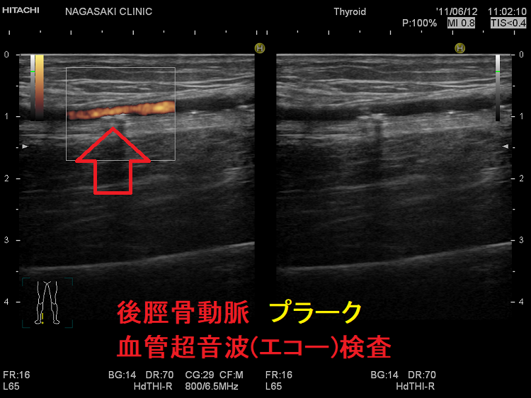 後脛骨動脈動脈 プラーク 血管超音波(エコー)検査 後脛骨動脈動脈 プラーク 血管超音波(エコー)検査