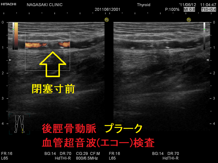 後脛骨動脈 プラーク 血管超音波(エコー)検査 後脛骨動脈 プラーク 血管超音波(エコー)検査