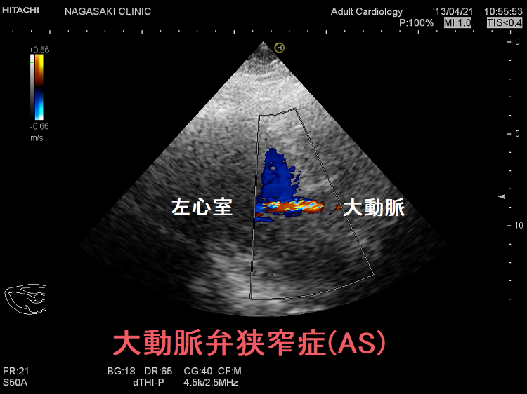 大動脈弁狭窄症(AS) 大動脈弁狭窄症(AS)