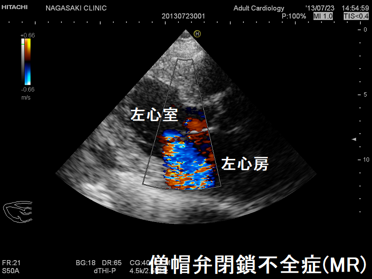 僧帽弁閉鎖不全症(MR) 心エコー 僧帽弁閉鎖不全症(MR) 心エコー