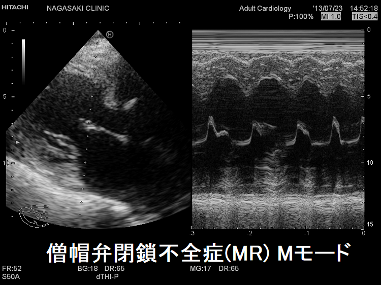 僧帽弁閉鎖不全症(MR) 心エコー Mモード 僧帽弁閉鎖不全症(MR) 心エコー Mモード