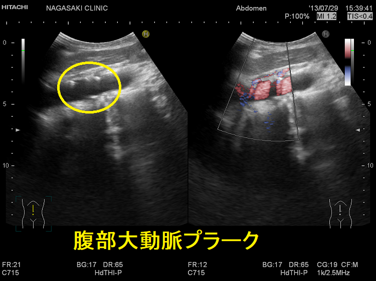 腹部大動脈プラーク 腹部大動脈プラーク