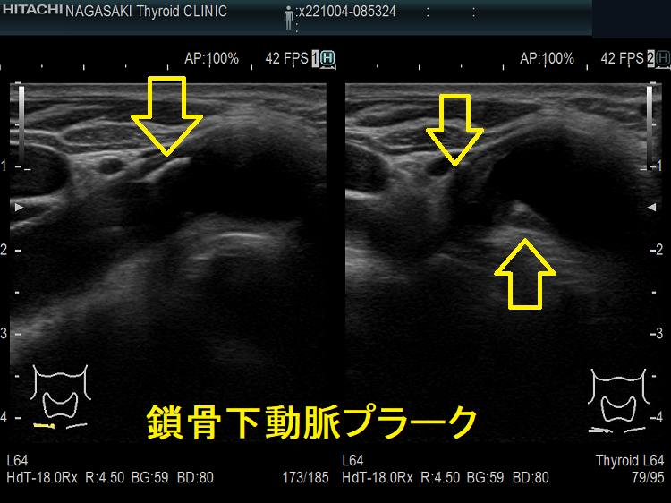 鎖骨下動脈プラーク 超音波(エコー)画像 鎖骨下動脈プラーク 超音波(エコー)画像