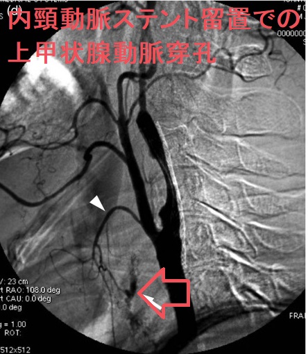 内頸動脈ステント留置での上甲状腺動脈穿孔 内頸動脈ステント留置での上甲状腺動脈穿孔
