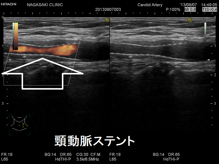 頸動脈ステント 超音波(エコー)画像2 頸動脈ステント 超音波(エコー)画像2