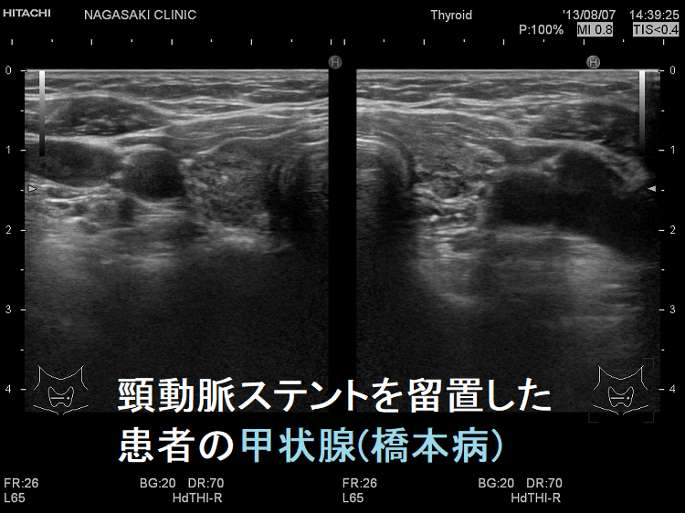 頸動脈ステントを留置した患者の甲状腺 超音波(エコー)画像 頸動脈ステントを留置した患者の甲状腺 超音波(エコー)画像