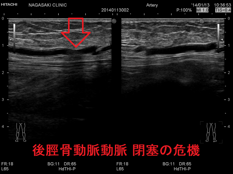 後脛骨動脈動脈 閉塞の危機 血管超音波(エコー)検査 後脛骨動脈動脈 閉塞の危機 血管超音波(エコー)検査