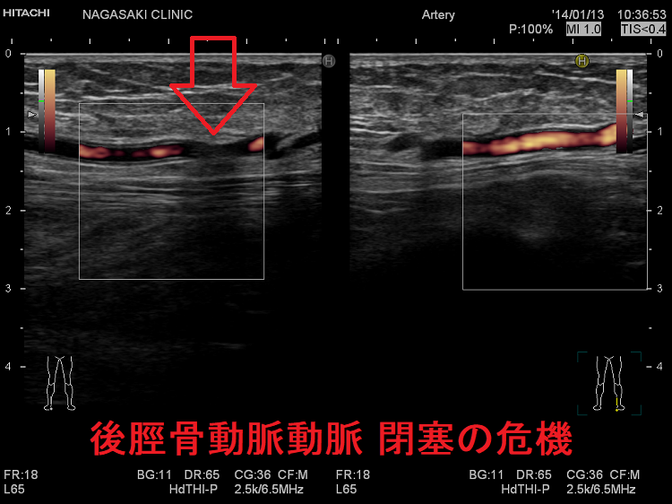 後脛骨動脈動脈 閉塞の危機 血管超音波(エコー)検査 ドプラーモード 後脛骨動脈動脈 閉塞の危機 血管超音波(エコー)検査 ドプラーモード