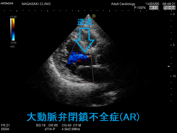大動脈弁閉鎖不全症(AR) 大動脈弁閉鎖不全症(AR)