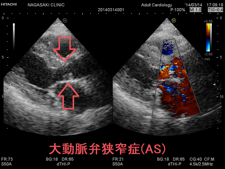 甲状腺と心臓弁膜症[橋本病 バセドウ病 甲状腺超音波検査 甲状腺