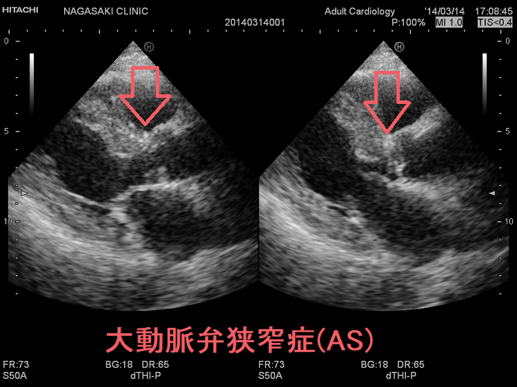 大動脈弁狭窄症(AS) 心エコー 大動脈弁狭窄症(AS) 心エコー
