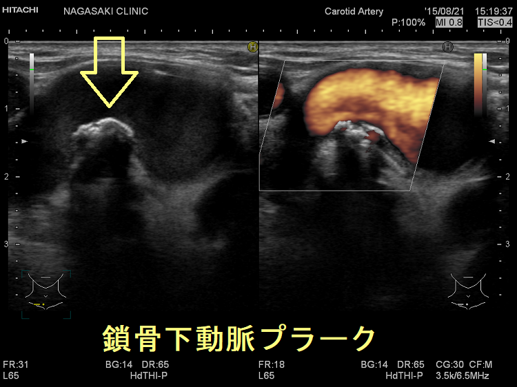 鎖骨下動脈プラーク 鎖骨下動脈プラーク