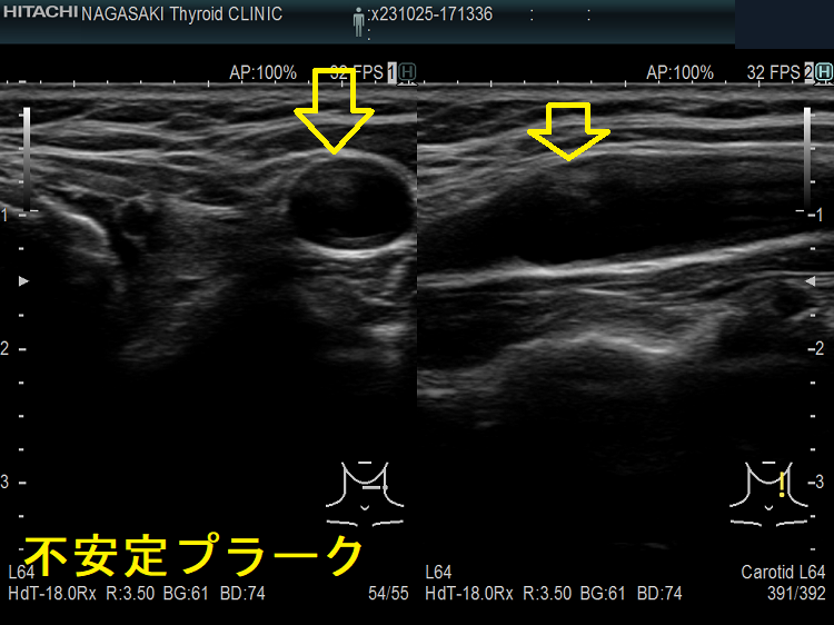 頸動脈不安定プラーク 超音波(エコー)画像 頸動脈不安定プラーク 超音波(エコー)画像