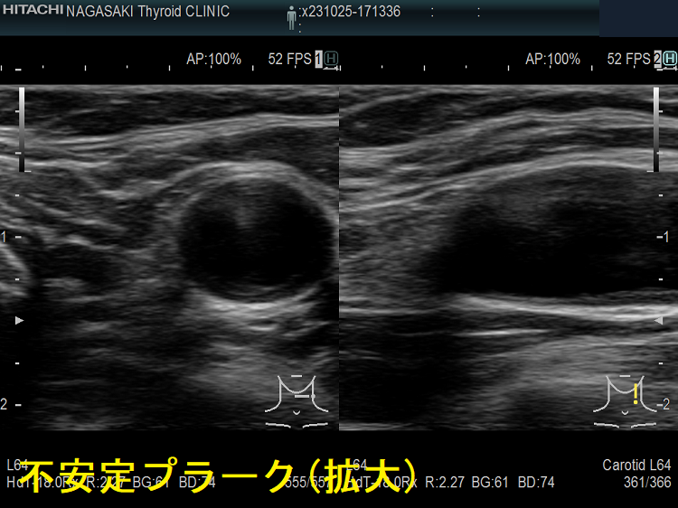 頸動脈不安定プラーク 超音波(エコー)画像(拡大) 頸動脈不安定プラーク 超音波(エコー)画像(拡大)