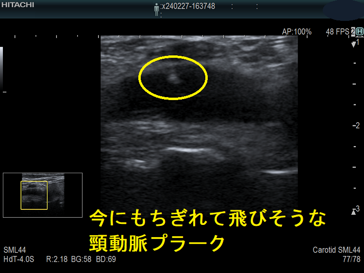 今にもちぎれて飛びそうな頸動脈プラーク 今にもちぎれて飛びそうな頸動脈プラーク