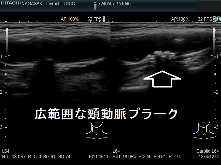 広範囲な頸動脈プラーク 広範囲な頸動脈プラーク