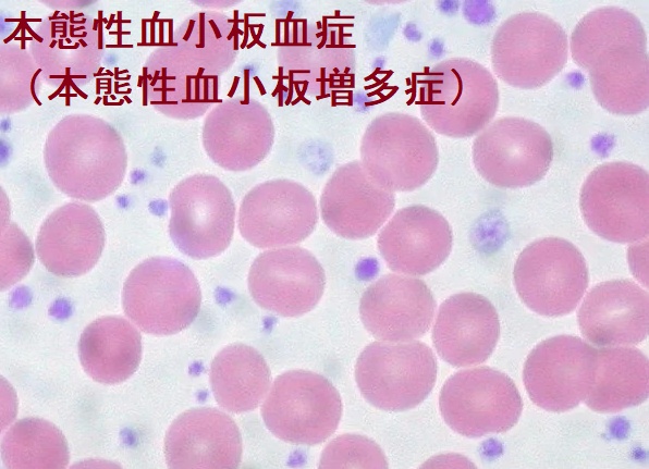 本態性血小板血症(本態性血小板増多症) 本態性血小板血症(本態性血小板増多症)