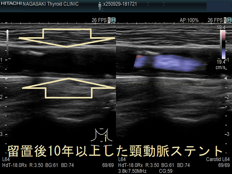 留置後10年以上した頸動脈ステント 超音波(エコー)画像 留置後10年以上した頸動脈ステント 超音波(エコー)画像