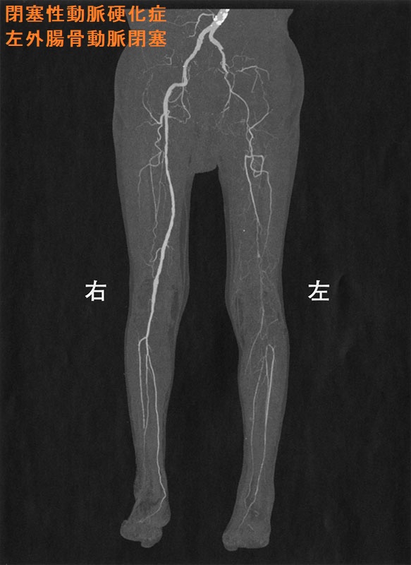閉塞性動脈硬化症 左外腸骨動脈閉塞 三次元CT 血管撮影像 閉塞性動脈硬化症 左外腸骨動脈閉塞 三次元CT 血管撮影像