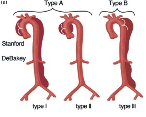 急性大動脈解離 スタンフォード分類 デベーキー分類 急性大動脈解離 スタンフォード分類 デベーキー分類
