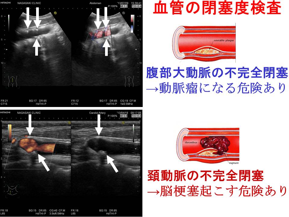 腹部大動脈プラーク・頚動脈プラーク 腹部大動脈プラーク・頚動脈プラーク