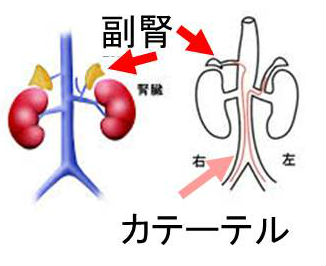 副腎静脈サンプリング 副腎静脈サンプリング