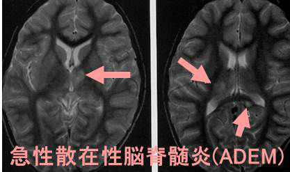 急性散在性脳脊髄炎(ADEM:acute disseminated encephalomyelitis) 急性散在性脳脊髄炎(ADEM:acute disseminated encephalomyelitis)