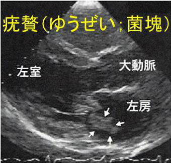 感染性心内膜炎 感染性心内膜炎
