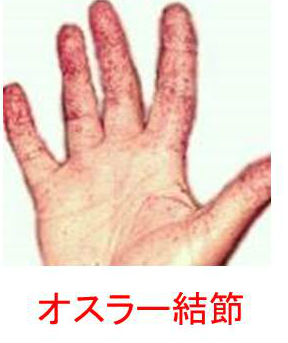 オスラー結節 オスラー結節