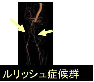 Leriche症候群 Leriche症候群