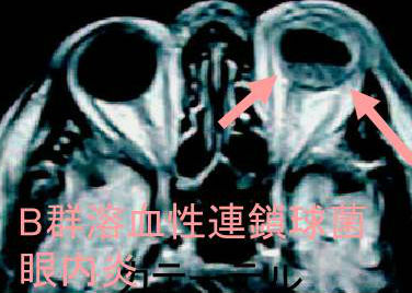 B群溶血性連鎖球菌 眼内炎 B群溶血性連鎖球菌 眼内炎