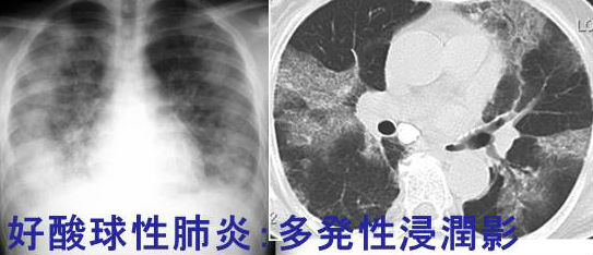 好酸球性肺炎 好酸球性肺炎