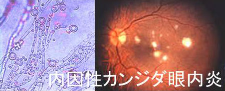 内因性真菌性眼内炎(カンジダ) 内因性真菌性眼内炎(カンジダ)